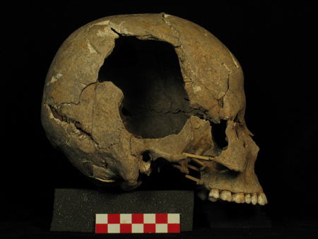 Skull of a 20-24 year-old woman.